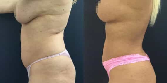liposuction colombia 358 - 2-min