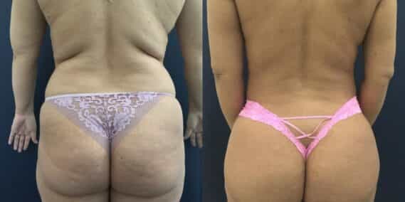 liposuction colombia 358 - 4-min