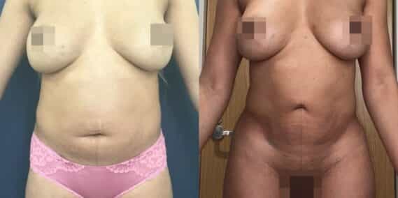 liposuction colombia 363 - 1-min