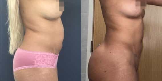 liposuction colombia 363 - 2-min