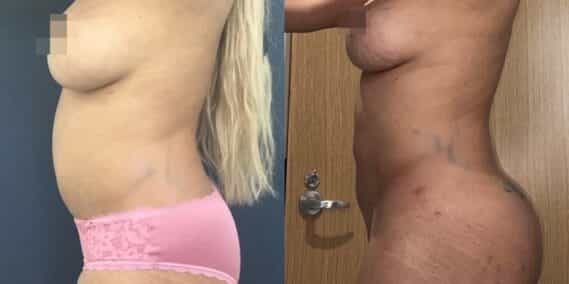 liposuction colombia 363 - 3-min