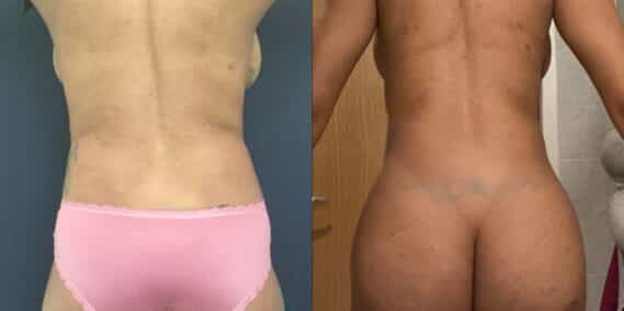 liposuction colombia 363 - 4-min