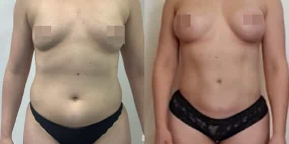 liposuction colombia 366 - 1-min