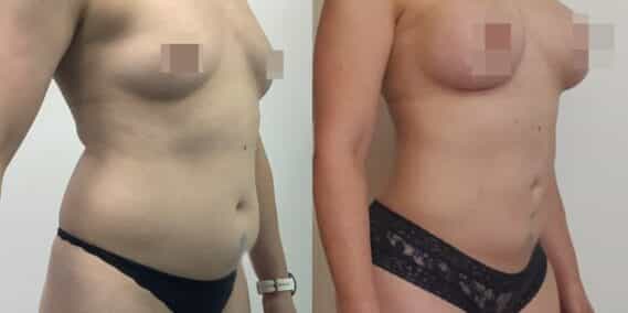 liposuction colombia 366 - 4-min