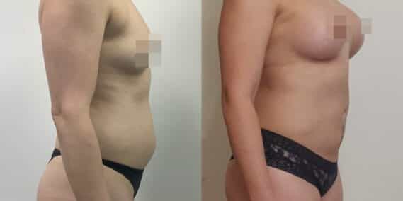 liposuction colombia 366 - 5-min
