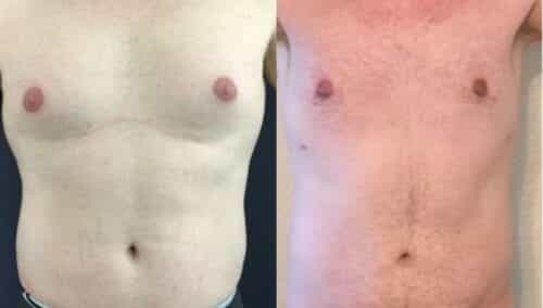 male reduction colombia 258-1-min