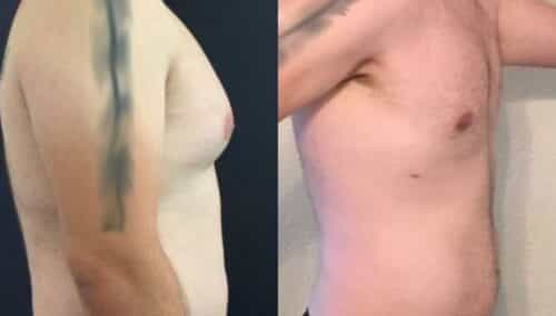 male reduction colombia 258-5-min