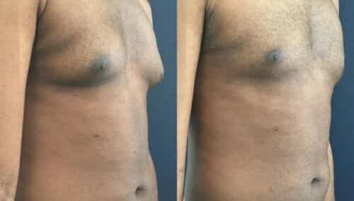 male reduction colombia 319-3-min