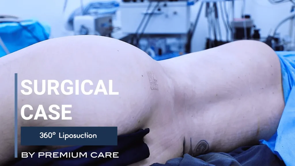 360 liposuction in colombia
