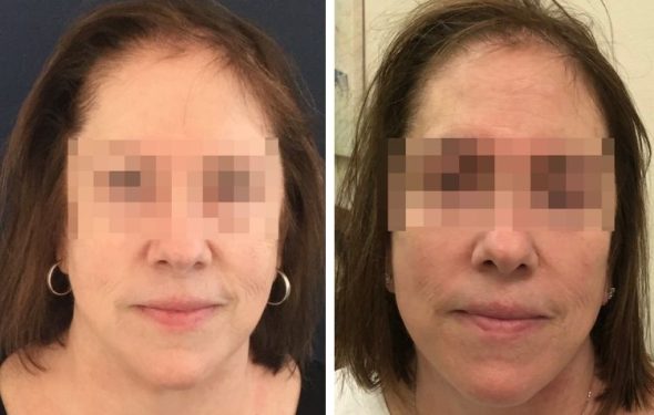 deep plane facelift colombia - premium care plastic surgery