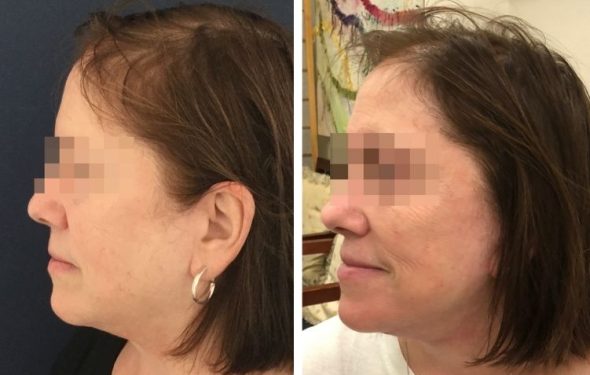 deep plane facelift colombia - premium care plastic surgery