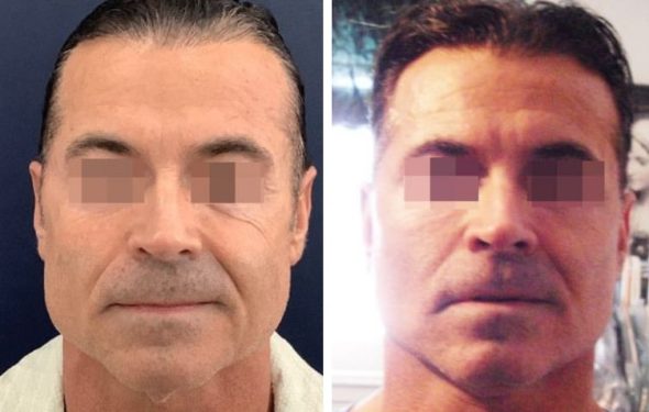 deep plane facelift colombia - premium care plastic surgery