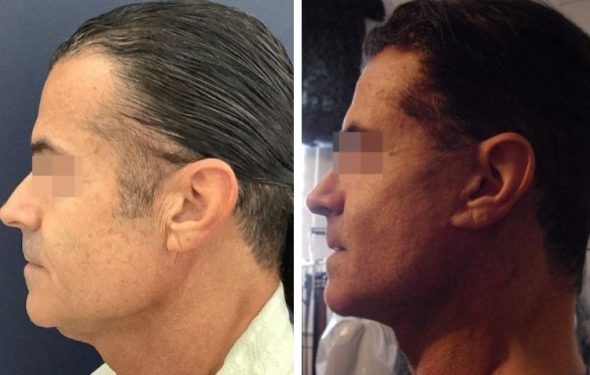 deep plane facelift colombia - premium care plastic surgery