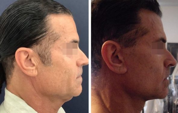 deep plane facelift colombia - premium care plastic surgery