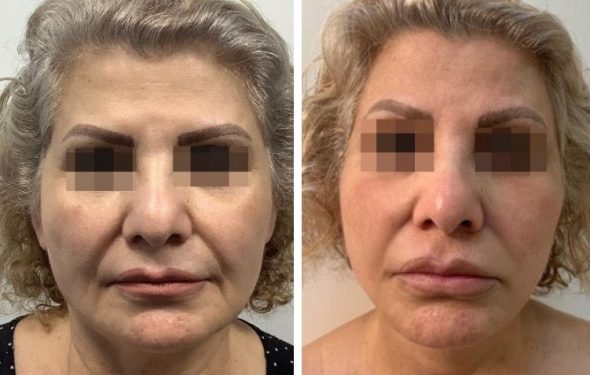 deep plane facelift colombia - premium care plastic surgery