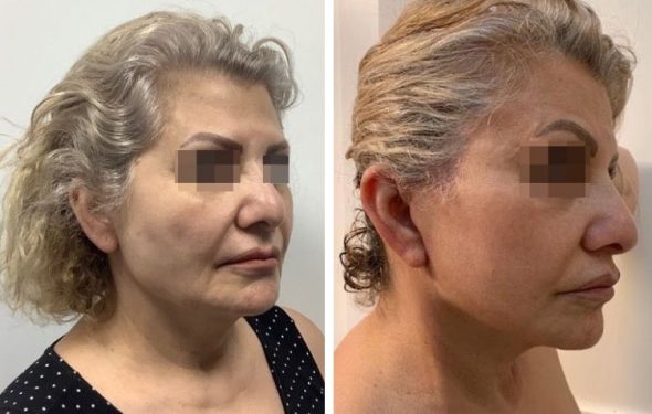 deep plane facelift colombia - premium care plastic surgery