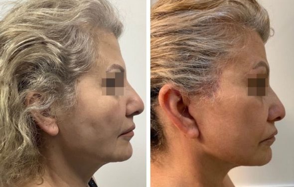 deep plane facelift colombia - premium care plastic surgery