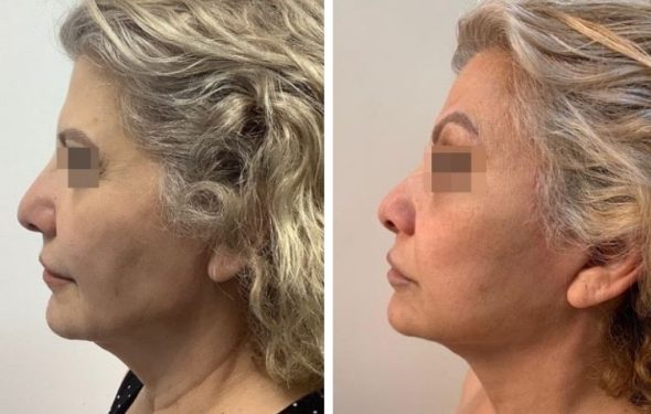 deep plane facelift colombia - premium care plastic surgery