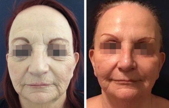 deep plane facelift colombia - premium care plastic surgery