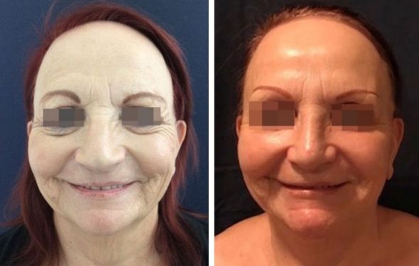 deep plane facelift colombia - premium care plastic surgery