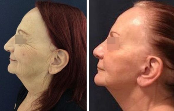 deep plane facelift colombia - premium care plastic surgery