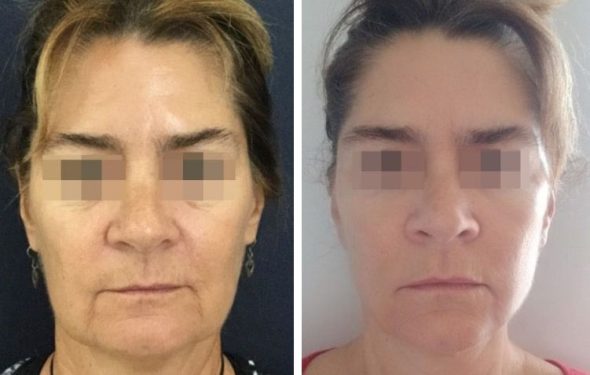 deep plane facelift colombia - premium care plastic surgery