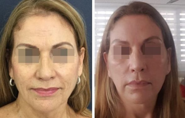 deep plane facelift colombia - premium care plastic surgery