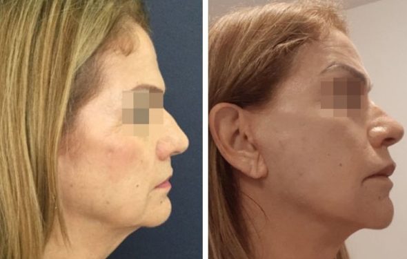 deep plane facelift colombia - premium care plastic surgery