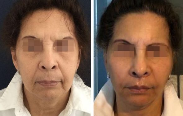 deep plane facelift colombia - premium care plastic surgery