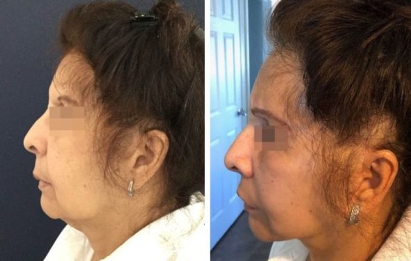 deep plane facelift colombia - premium care plastic surgery