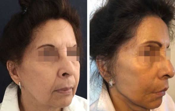 deep plane facelift colombia - premium care plastic surgery