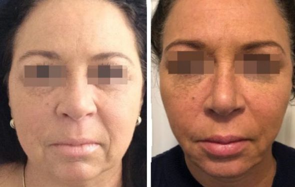 deep plane facelift colombia - premium care plastic surgery