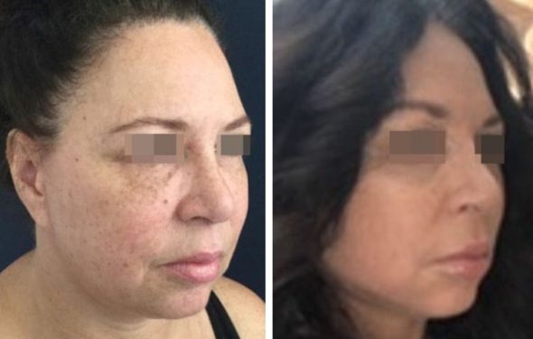 deep plane facelift colombia - premium care plastic surgery