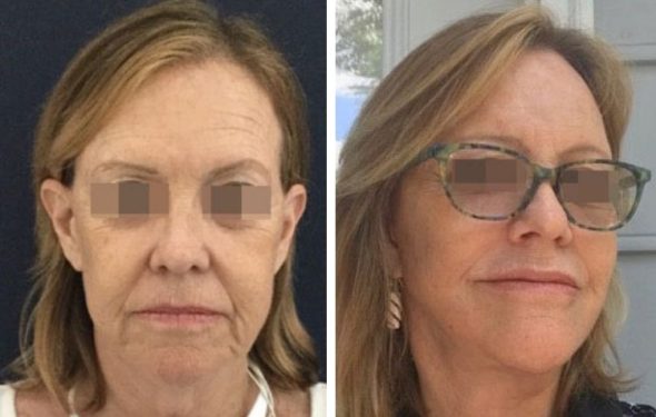 deep plane facelift colombia - premium care plastic surgery