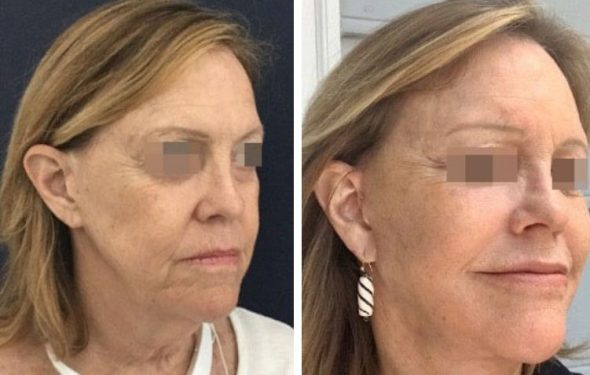 deep plane facelift colombia - premium care plastic surgery