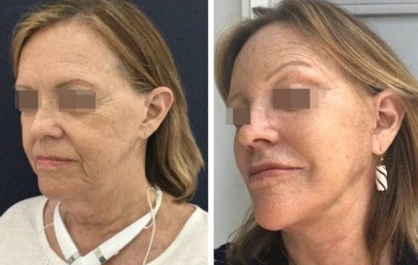 deep plane facelift colombia - premium care plastic surgery