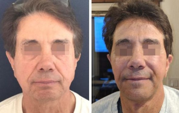 deep plane facelift colombia - premium care plastic surgery