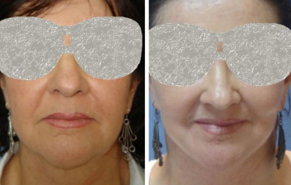 Facelift Colombia - Premium Care Plastic Surgery