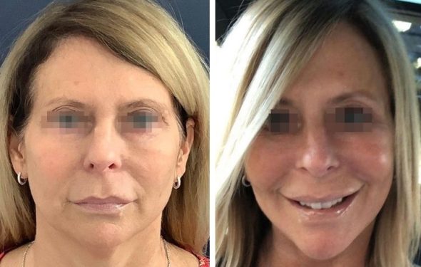 deep plane facelift colombia - premium care plastic surgery