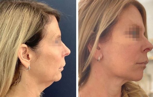 deep plane facelift colombia - premium care plastic surgery