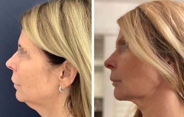 deep plane facelift colombia - premium care plastic surgery