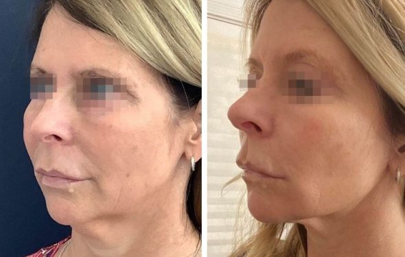 deep plane facelift colombia - premium care plastic surgery