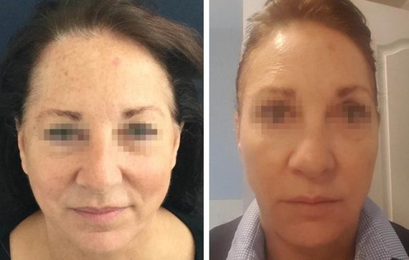 deep plane facelift colombia - premium care plastic surgery