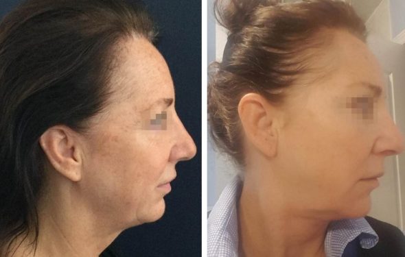 deep plane facelift colombia - premium care plastic surgery