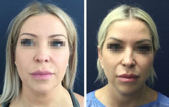 deep plane facelift colombia - premium care plastic surgery