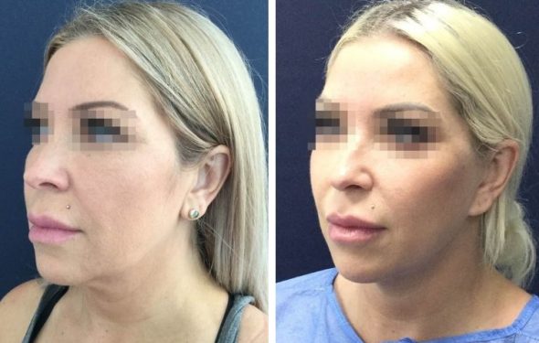 deep plane facelift colombia - premium care plastic surgery