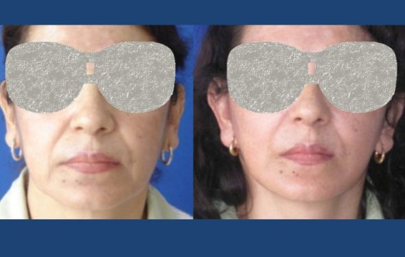 Facelift Colombia - Premium Care Plastic Surgery