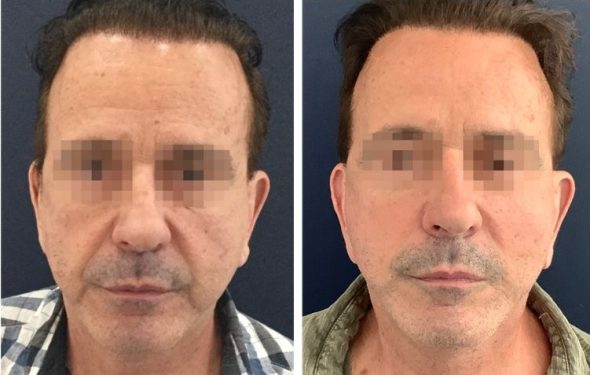 deep plane facelift colombia - premium care plastic surgery