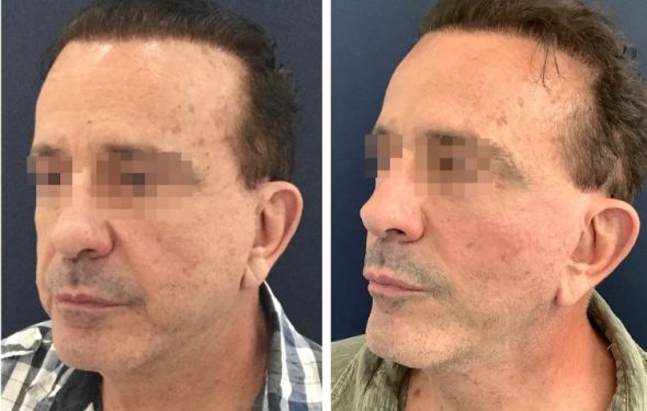 deep plane facelift colombia - premium care plastic surgery