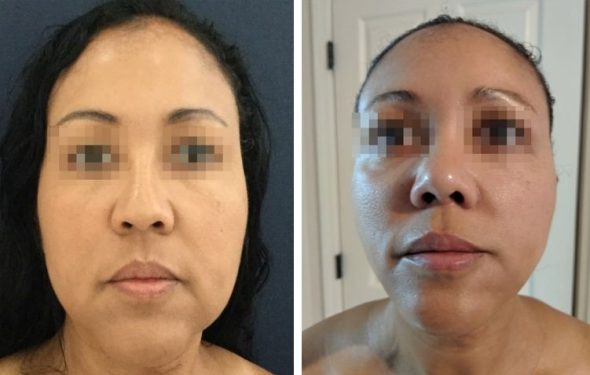 deep plane facelift colombia - premium care plastic surgery